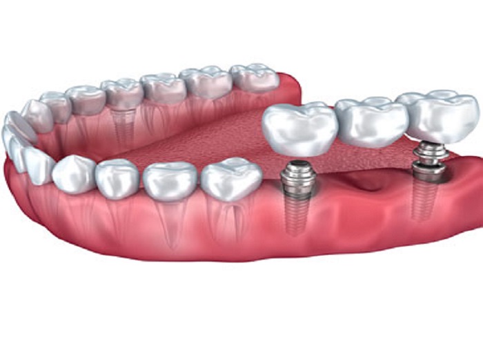 Dental Implants