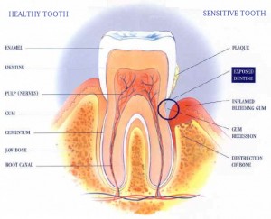 Sensitive Teeth