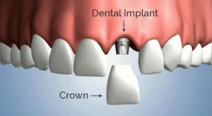 Dental Implants in Delhi