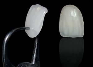 Ceramic Veneers