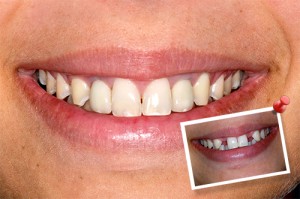 Dental Implants in Delhi