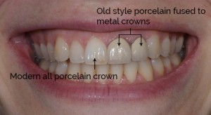 Porcelain Crowns