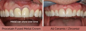 Dental Crowns