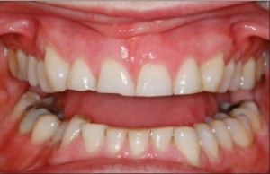 denta-attrition