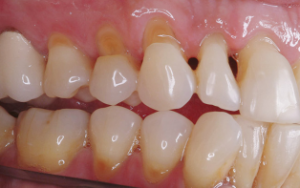 dental-abfraction