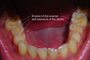 dental-erosion