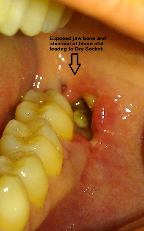 Dry socket teeth