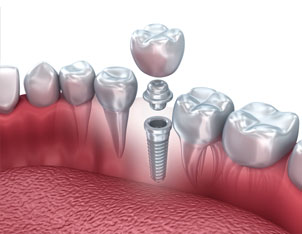 DENTAL IMPLANTS