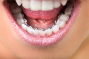 Lingual braces