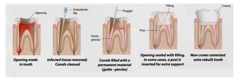Root Canal Treatments 
