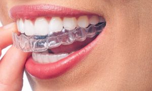 Invisalign