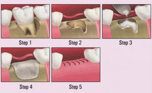Bone Grafts In Dentistry
