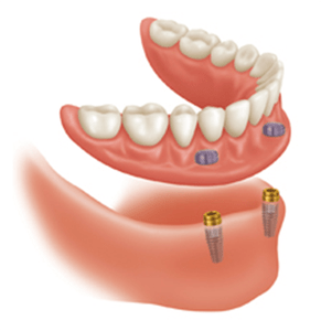 Implant-supported dentures