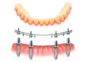 intra oral welding technique