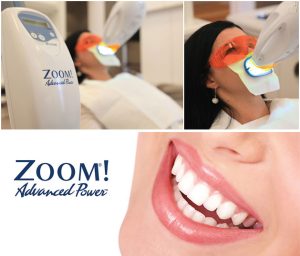 Zoom Teeth Whitening Treatment