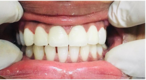 Ceramic Veneers in Delhi