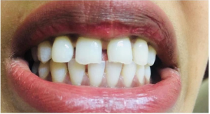 Ceramic Veneers in Delhi