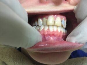 Smile Makeover