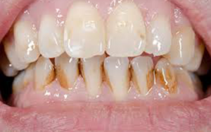 Extrinsic Teeth Stains
