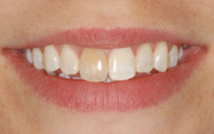 Intrinsic Teeth Stains