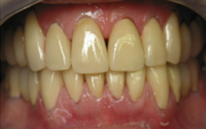 Age-Related Teeth Stains