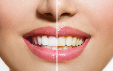 Teeth-Staining-Blog-Image