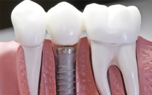 Dental implants