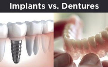 Dental Implants vs Dentures