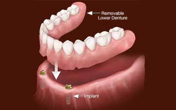 Implant-Supported-Dentures-Blog-Image-2_20201126