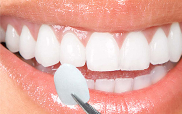 Porcelain Veneers