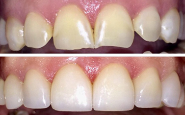 Composite Veneers