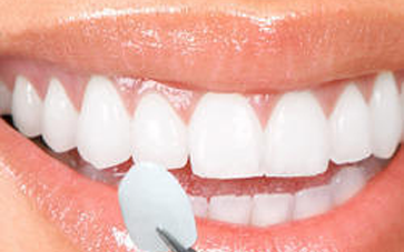 Porcelain veneer - Smile Delhi