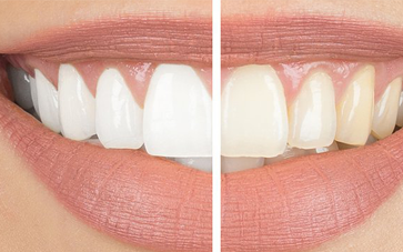 Teeth Whitening - Smile Delhi