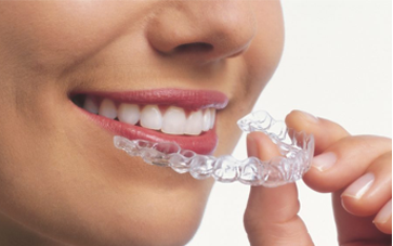 Invisalign Aligners - Smile Delhi