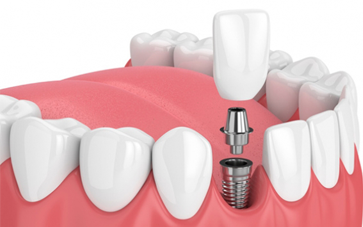 Dental Implants - Smile Delhi