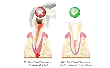 Successful Root Canal Treatment