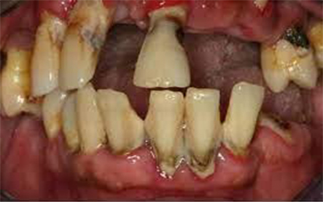 Oral Symptoms of Black Fungus