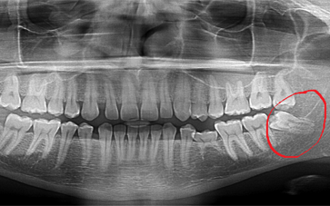 impacted wisdom tooth