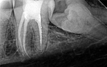 coronectomy treatment