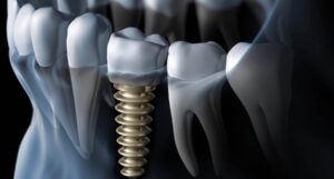 Dental Implants India