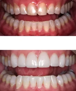 Porcelain Veneers