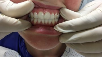 A Teeth Whitening Post