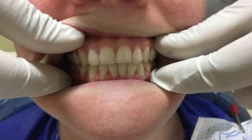A Teeth Whitening Pre