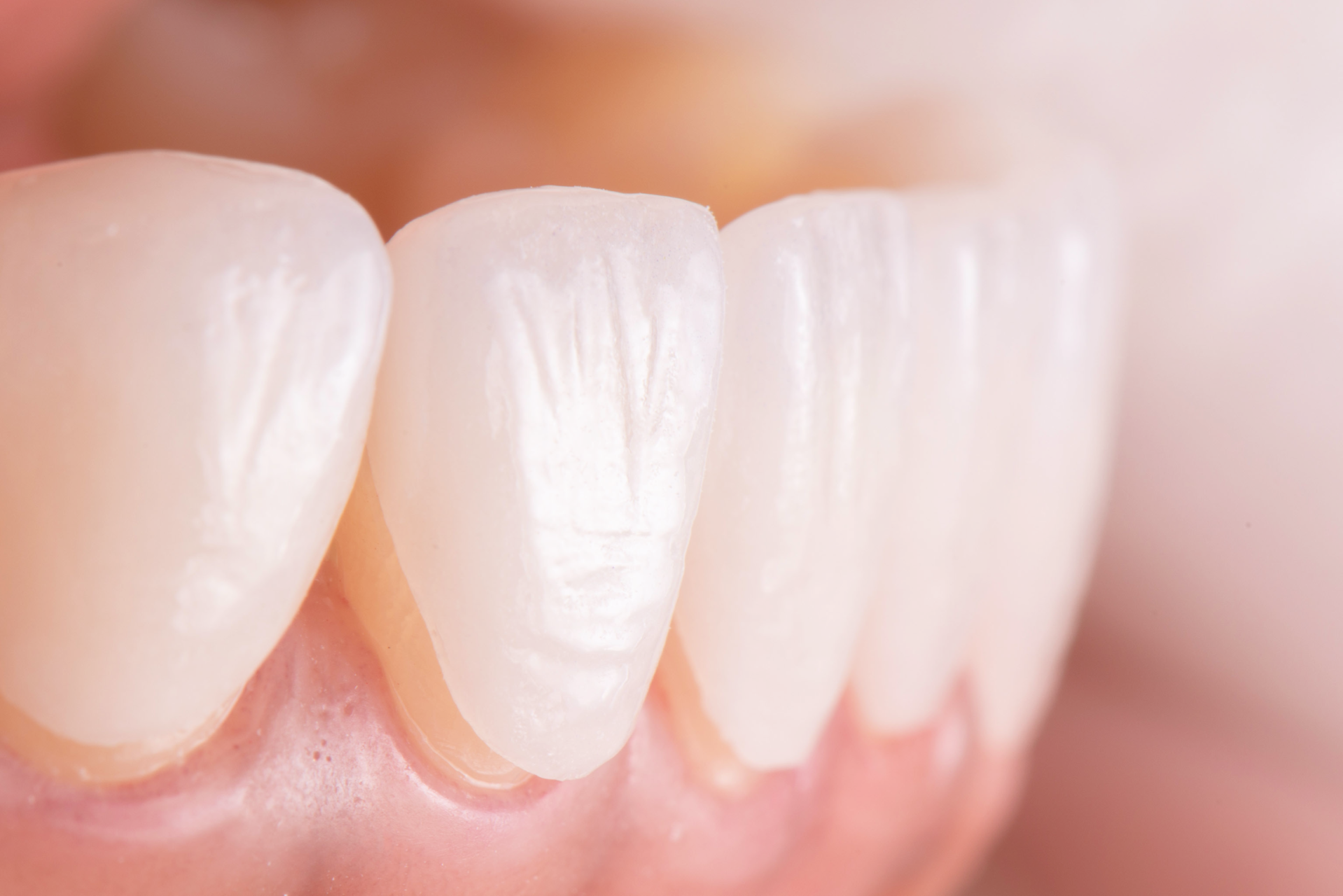 Teeth Whitening