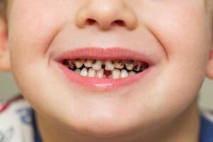 Cavities In Milk Teeth