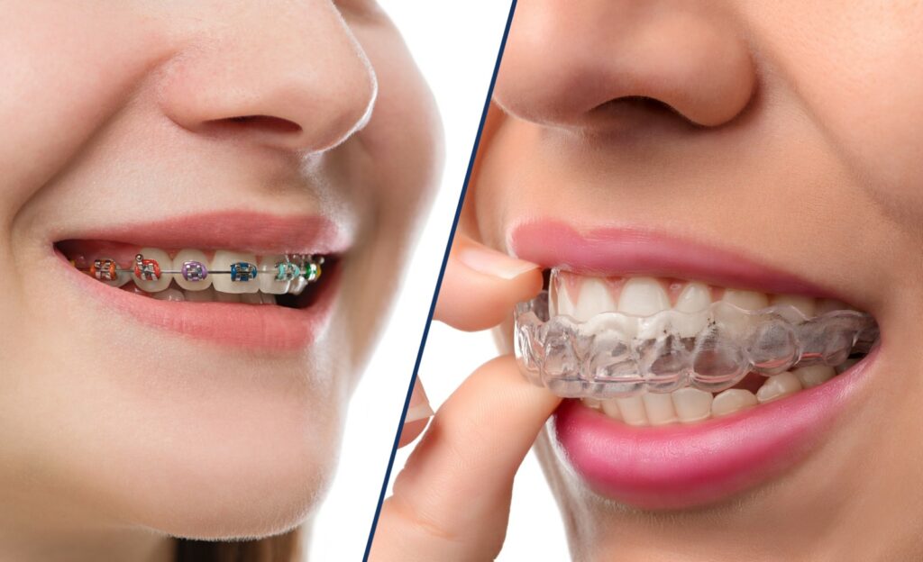 Invisalign Or Braces