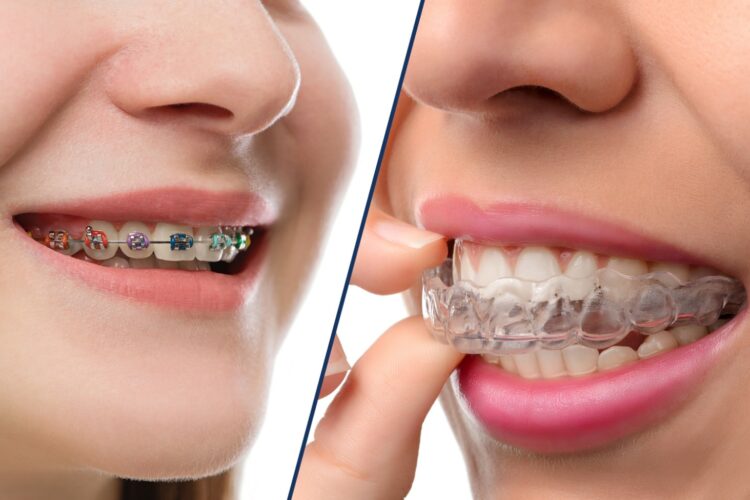 Invisalign Or Braces