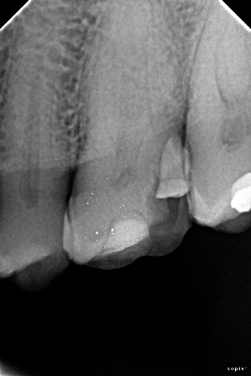 Chipped or Cracked Tooth