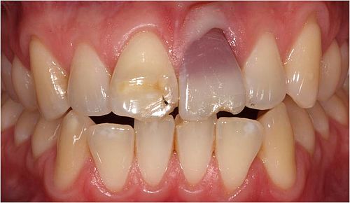 Tooth Discoloration