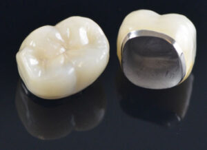 Porcelain Metal Crowns